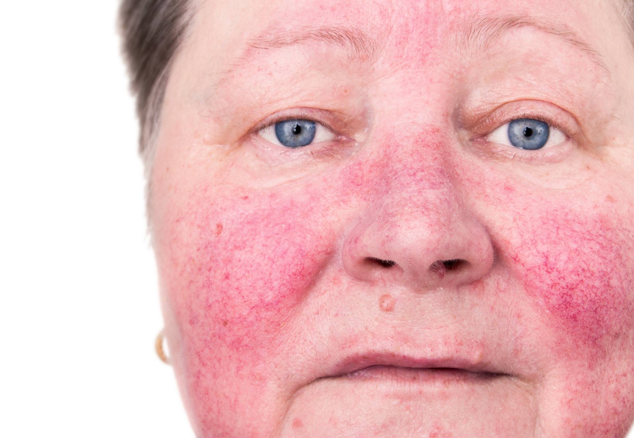 You are currently viewing April is Rosacea Awareness Month!